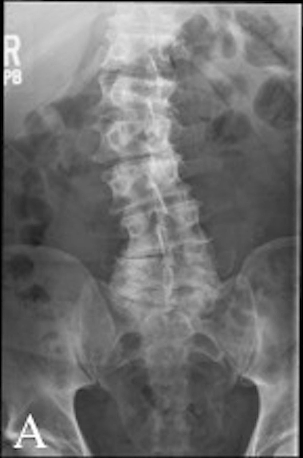 Pre-operative-anterior/posterior-X-rays.