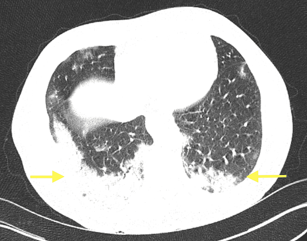 Braz J Cardiovasc Surg - Preoperative Left Ventricular Global