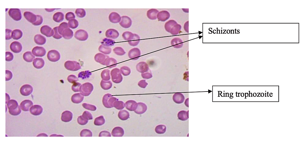 MDM detection of P. falciparum and P. vivax from a mixed blood sample.... |  Download Scientific Diagram