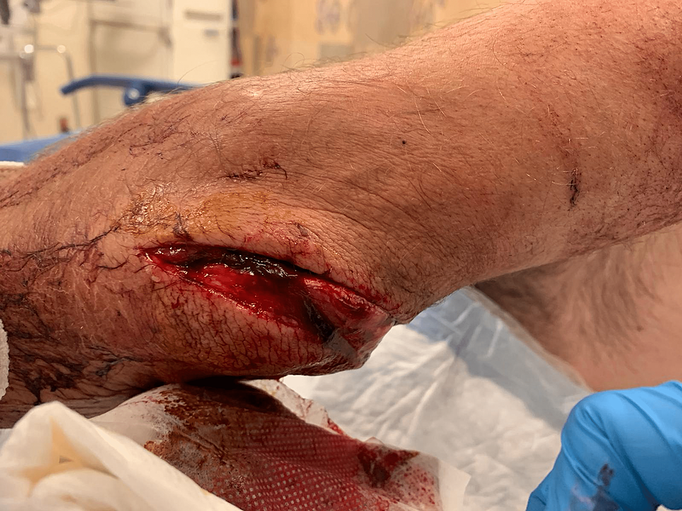 The patient's right leg indicating suture and surgical scars