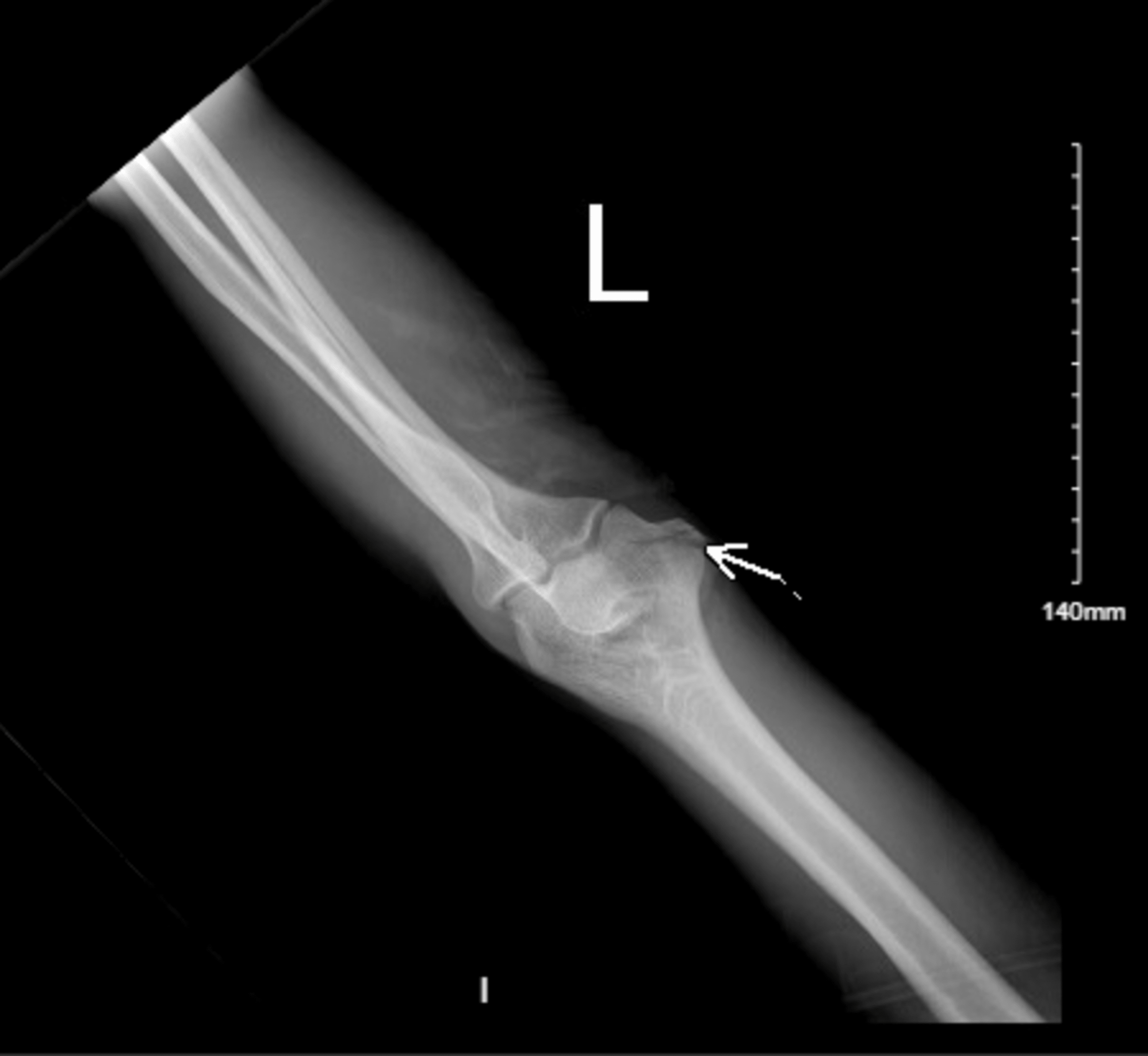 Cureus | A Case of an Ulnar Nerve Laceration With Distal Humerus ...