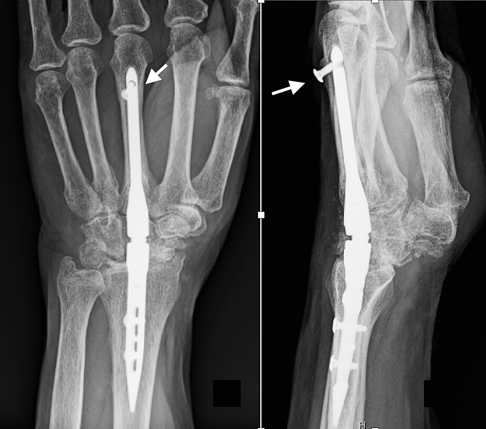 Cureus | Locked Intramedullary Total Wrist Arthrodesis: A Report Of ...