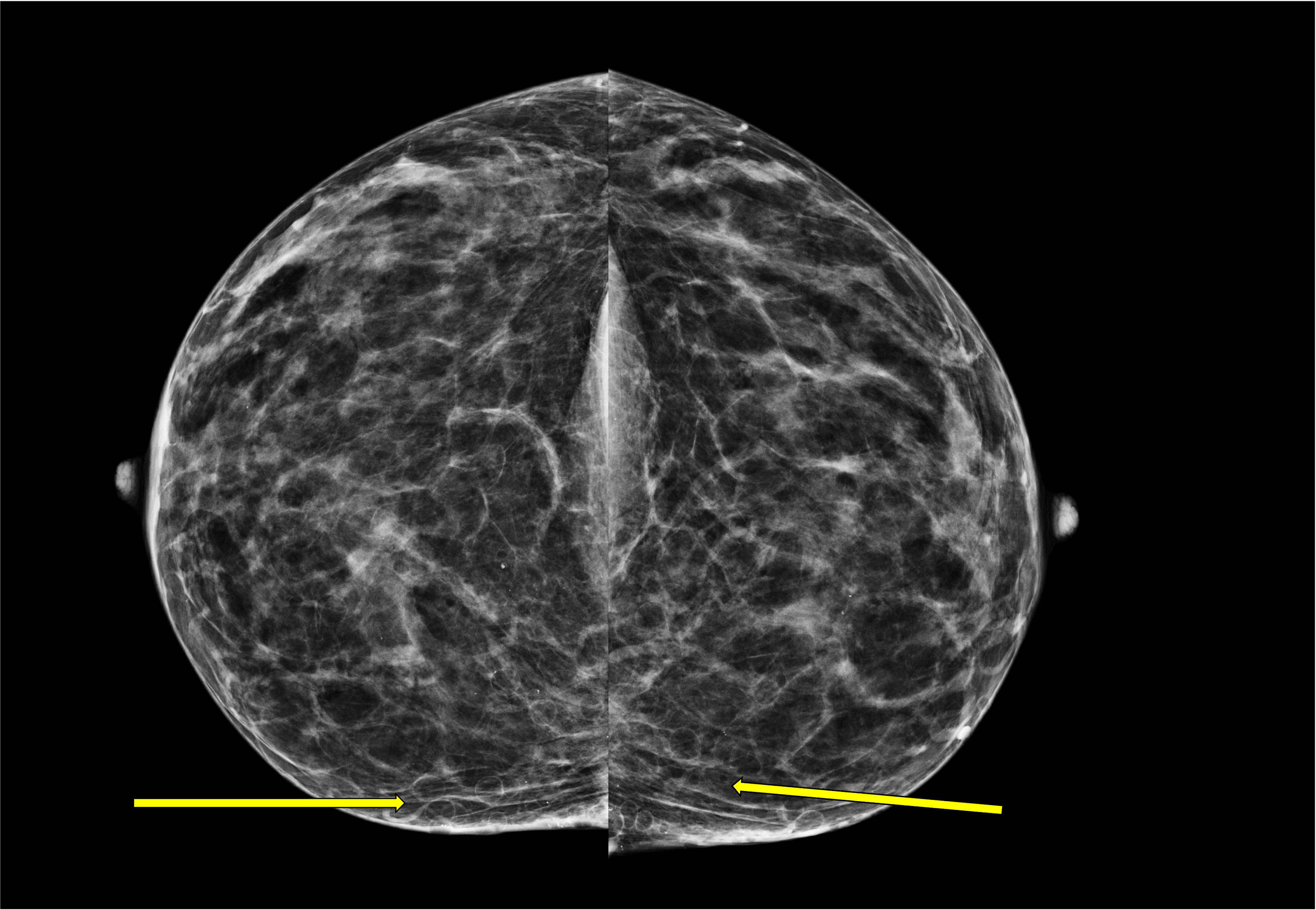 Cureus A Breast Imaging Case of Steatocystoma Multiplex A Rare Condition Involving Multiple