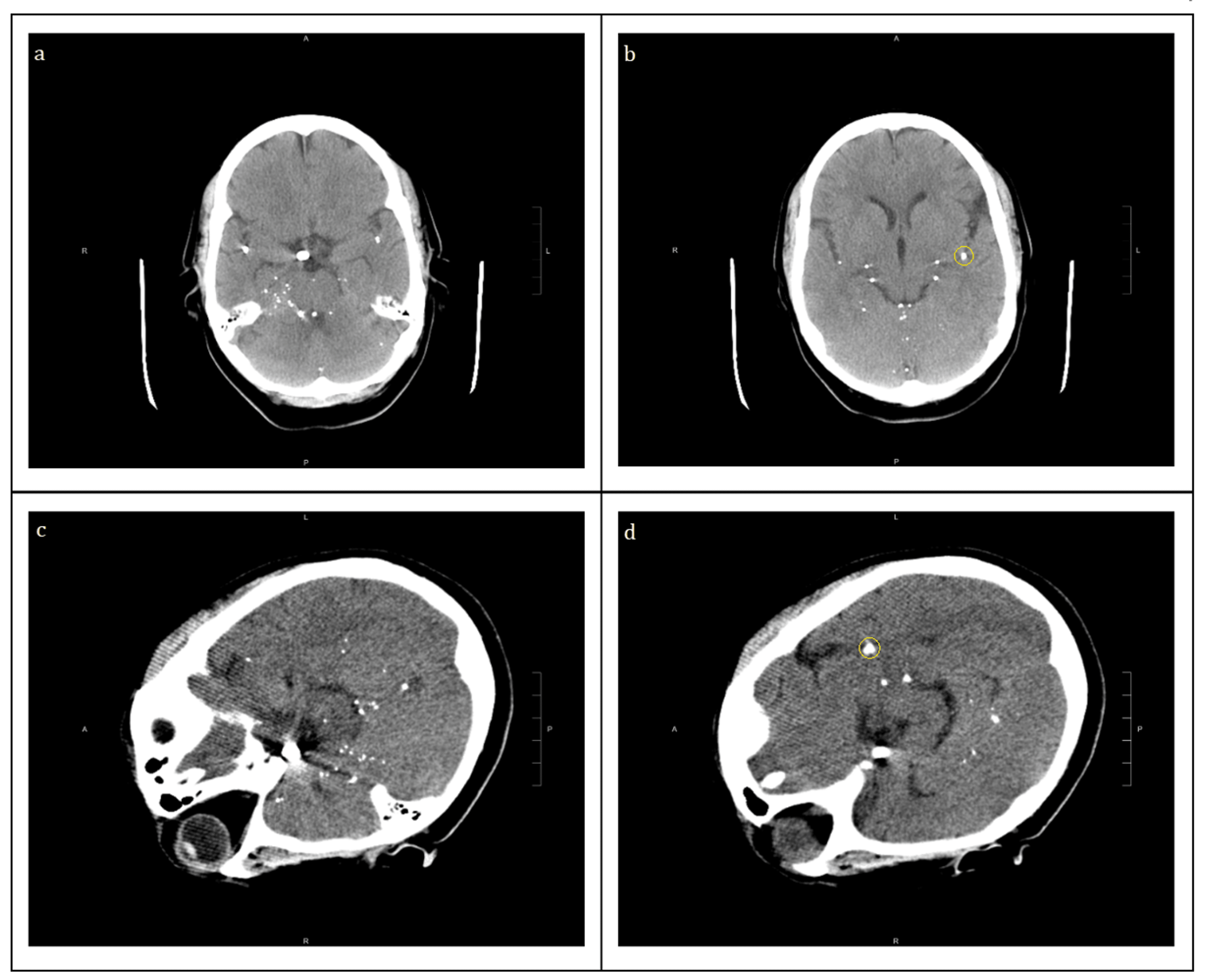 halloween sign ct scan epligotitis halloween sign ct scan epligotitis