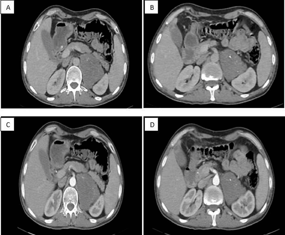 Cross-sectional-CT-scan-C--(A,-B),-C+-(C,D)-showing-the-triangular-left-adrenal-mass-with-calcification.