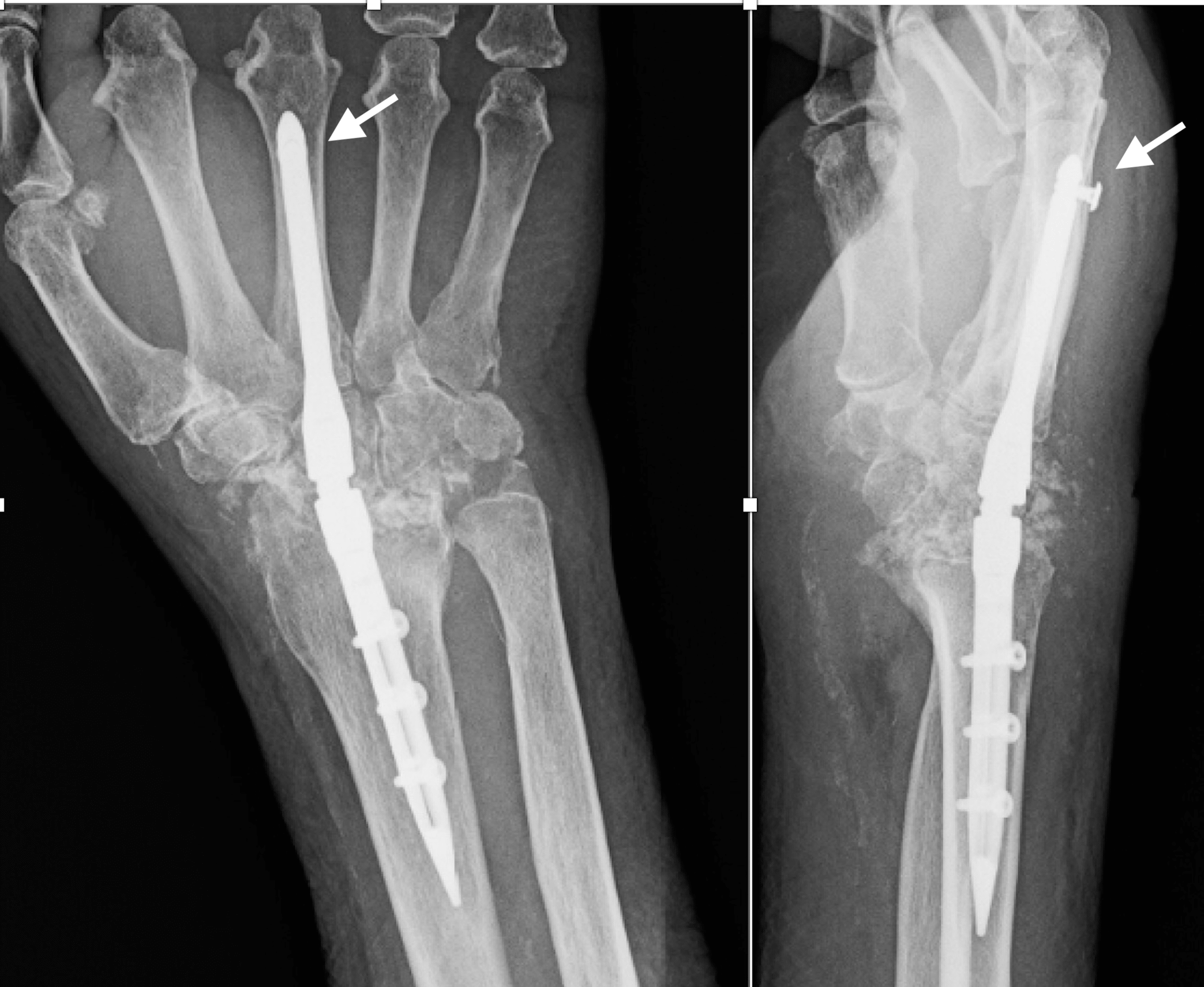 Cureus Locked Intramedullary Total Wrist Arthrodesis A Report of