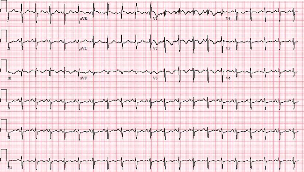 Electrocardiogram-showing-sinus-tachycardia-with-ST-segment-and-T-wave-abnormalities.