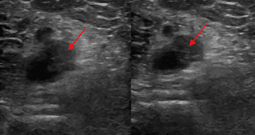 Doppler-ultrasound-showing-intraluminal-thrombus-extending-from-the-left-distal-popliteal-vein-to-the-left-peroneal-vein-(arrows).
