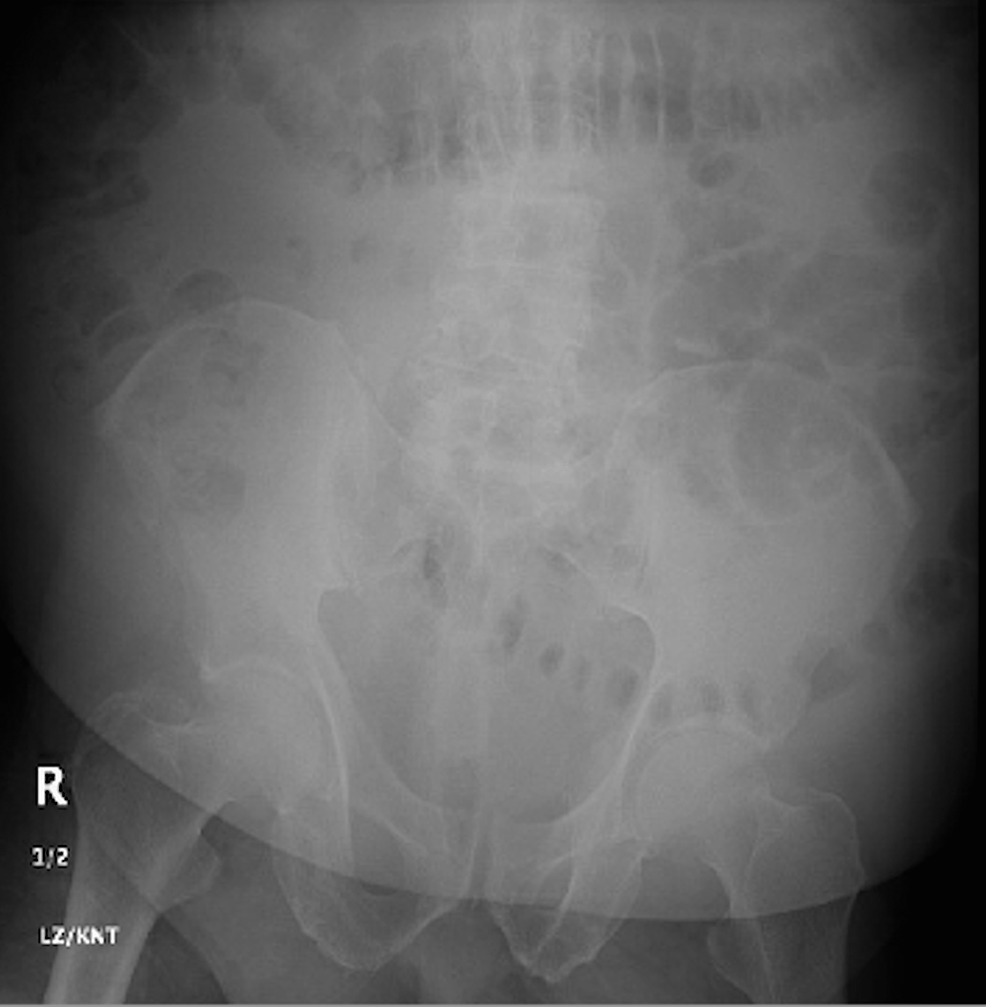 X-ray-showing-nonspecific-bowel-gas-pattern-with-no evidence-of-obstruction-and-no-evidence-of-any-renal-stones.