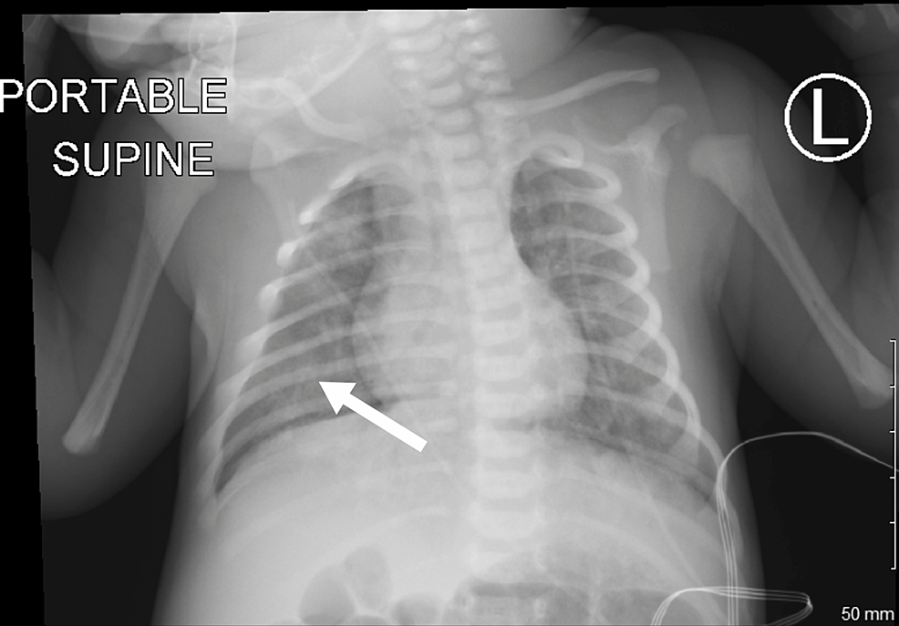 cureus-possible-covid-19-maternal-to-neonate-vertical-transmission-in