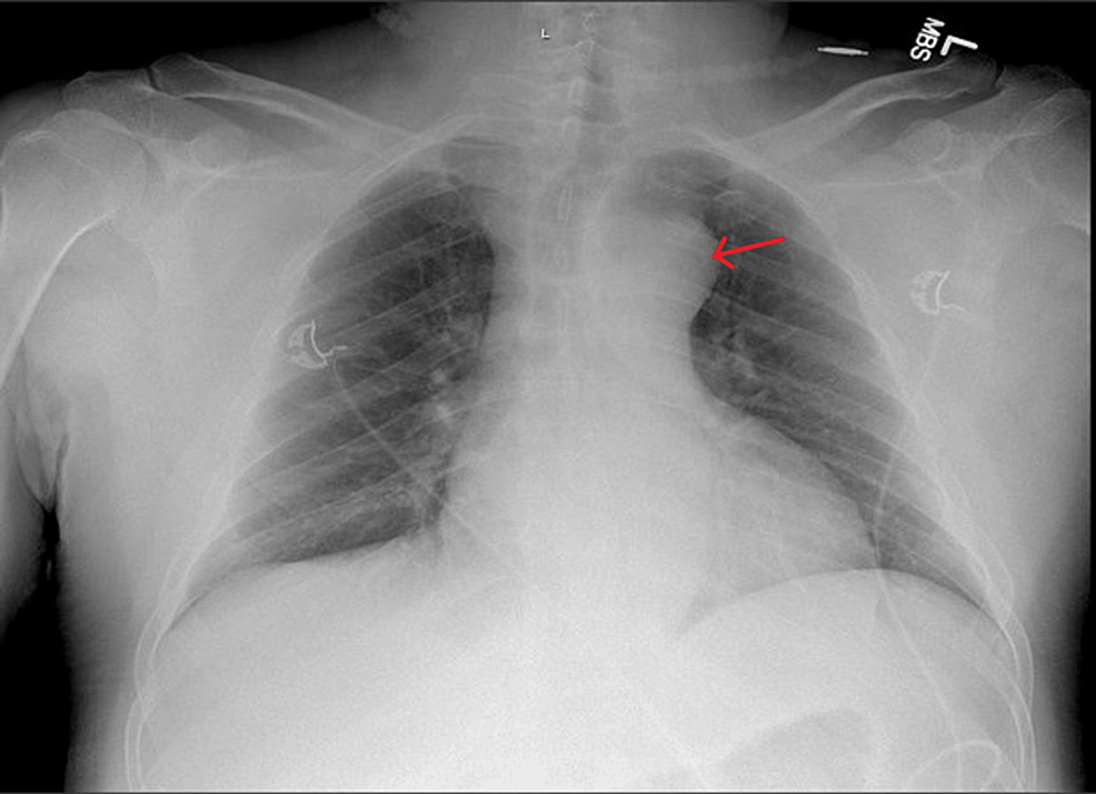 Cureus | Medically Managed Type A Thoracic Intramural Hematoma and ...