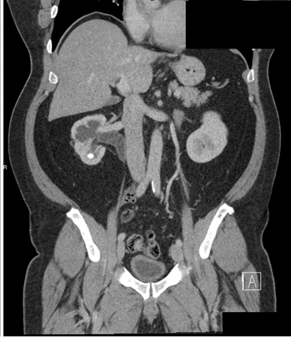 An Incidental Finding of Retrocaval Ureter Causing