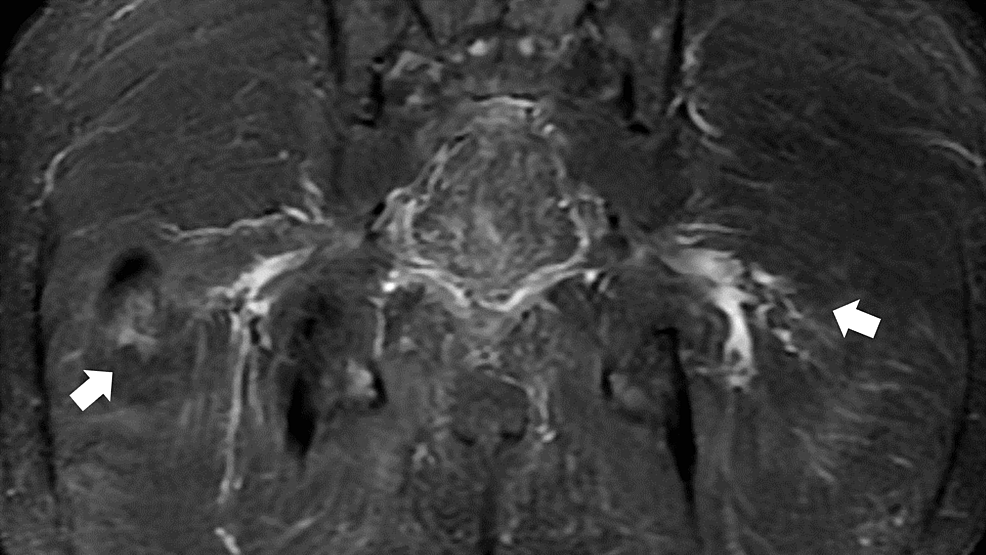 A-pelvic-magnetic-resonance-imaging-scan-(coronal-plane)-showing-high-signals-in-the-bilateral-sciatic-nerves-(arrows)