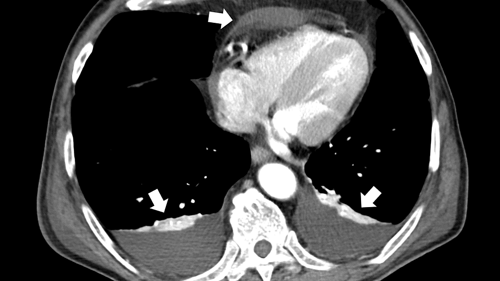 An-enhanced-abdominal-computed-tomography-scan-(transverse-plane)-showing-generalized-edema-of-the-periarterial-lesions-around-the-superior-and-inferior-mesenteric-arteries-(arrows).
