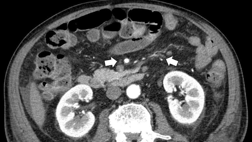 An-enhanced-abdominal-computed-tomography-scan-(transverse-plane)-showing-effusions-of-pericardial-and-pleural-fluid-(white-arrows)