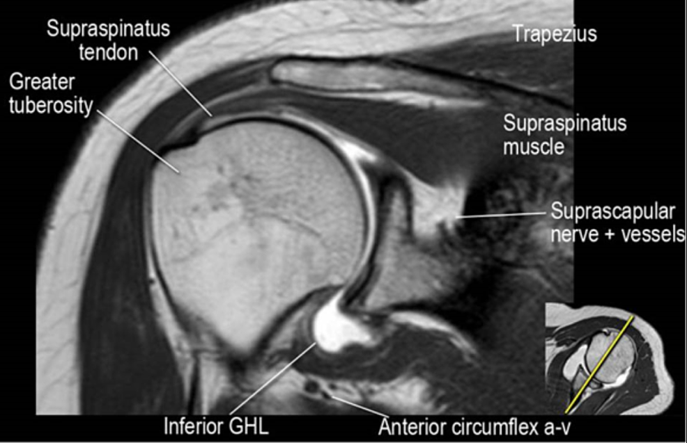 Cureus Technical Report Biodegradable Spacer Device For Irreparable Rotator Cuff Tears