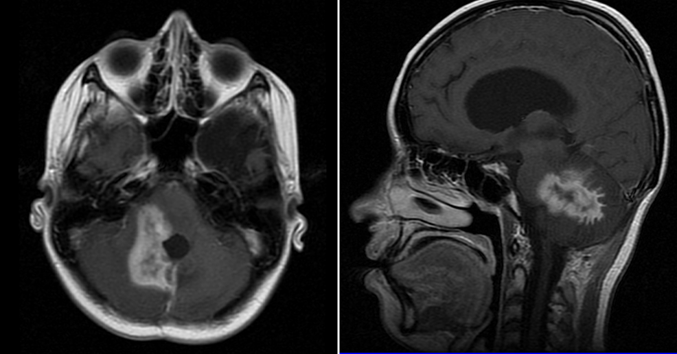 Cureus | Relapsed High-Risk Medulloblastoma: Stable Disease after Two ...