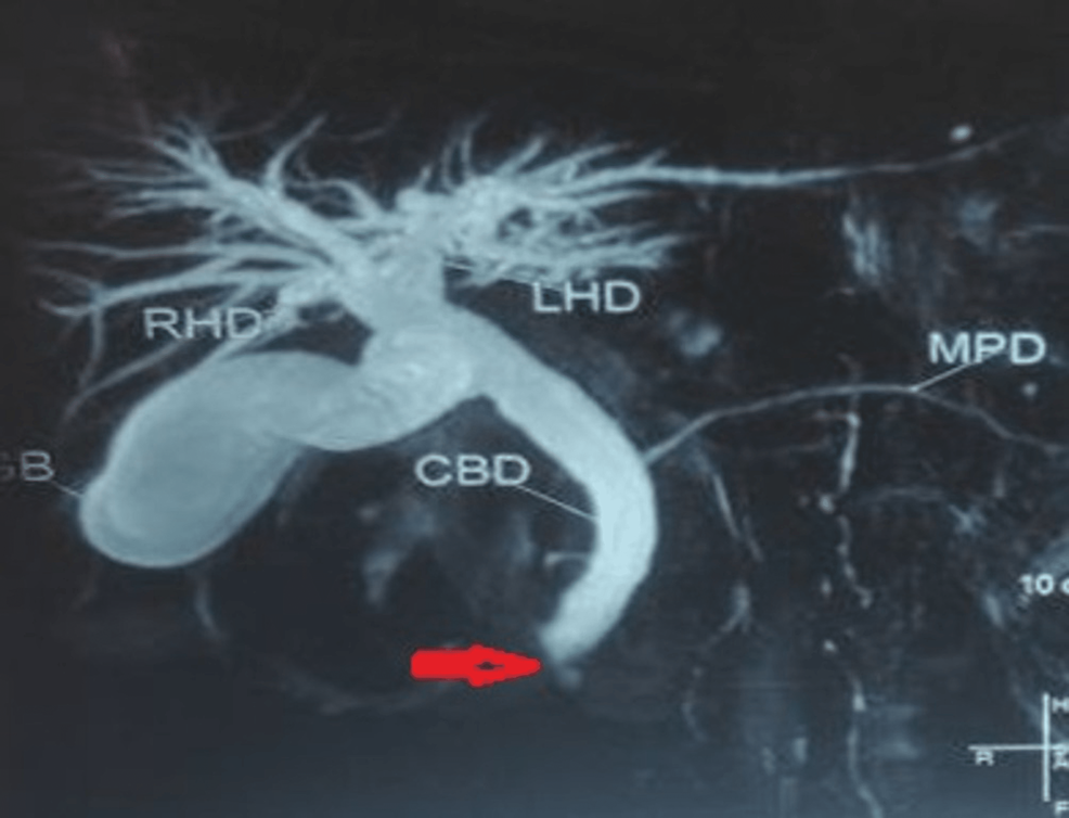 MRCP-shows-an-abrupt-cut-off-of-distal-CBD-(red-arrow)-due-to-the-periampullary-growth-in-a-patient-with-PD
