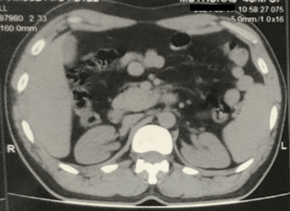 Computed-tomography-shows-dorsal-agenesis-in-a-patient-with-acute-mild-pancreatitis