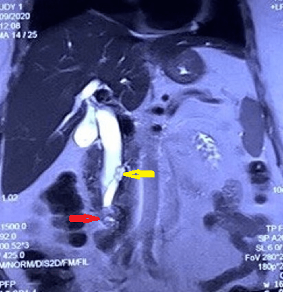 Magnetic-resonance-imaging-shows-an-absent-pancreatic-duct-in-the-body-and-tail-of-the-pancreas-(yellow-arrow)-with-a-mass-lesion-(red-arrow)-at-the-distal-common-bile-duct