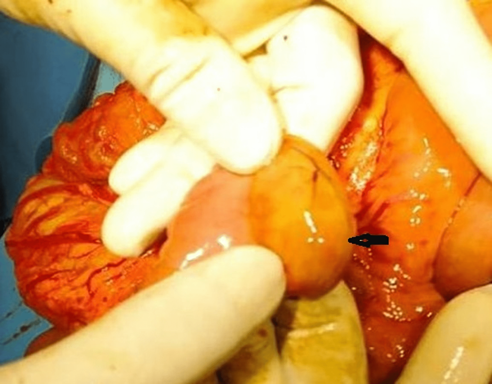 Intraoperative-image-of-the-ectopic-pancreas-(black-arrow)-in-the-proximal-jejunum