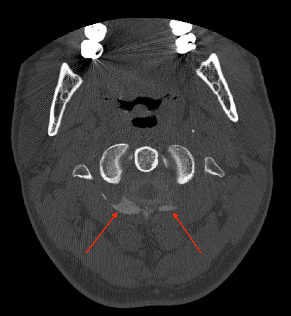 Axial-C1-C2-level-myelo-CT-showing-bilateral-contrast-outside-the-subarachnoid-space-(red-arrows),-as-evidence-of-C1-C2-CSF-fistulas.