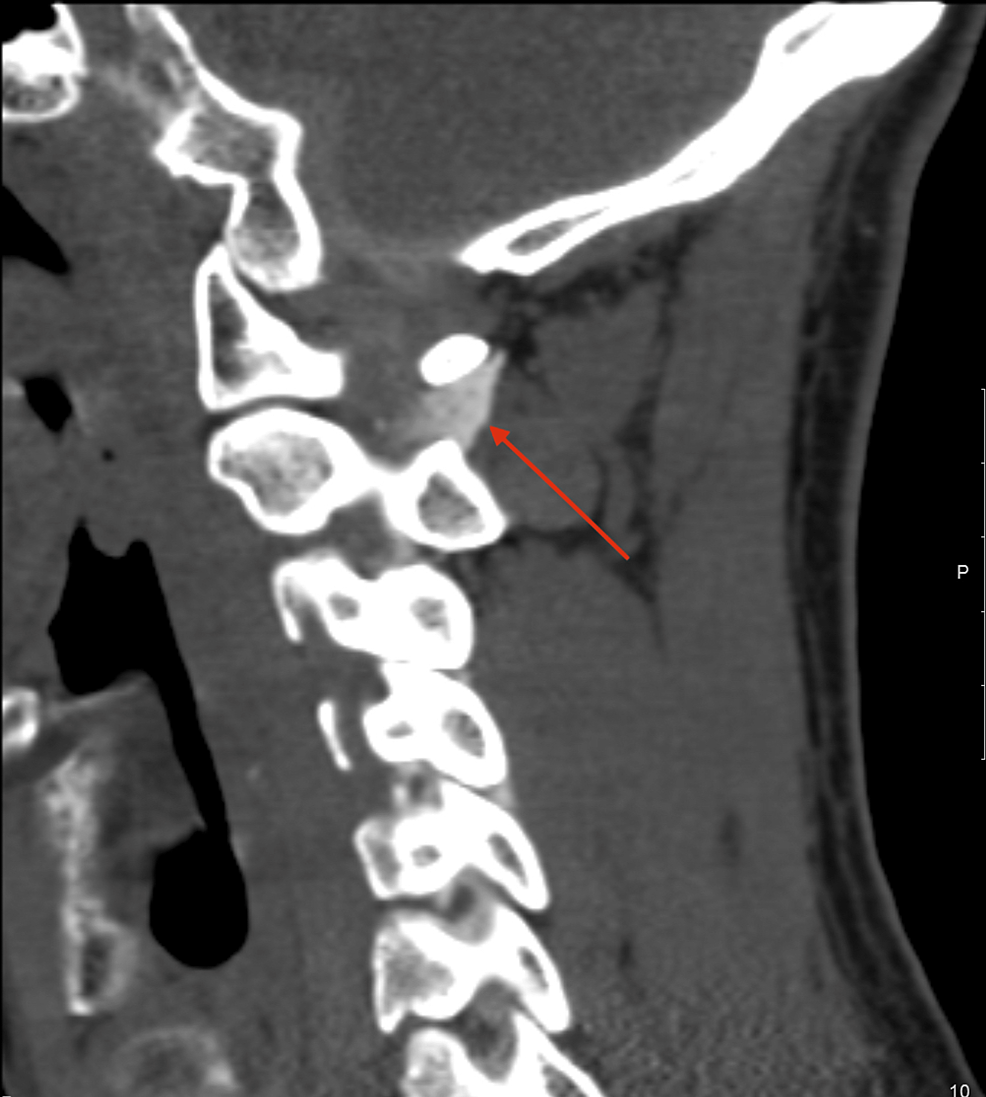 Parasagittal - cervical - bone marrow - CT - contrast - lateral - subarachnoid space - (red arrow) - right lateral - C1 - C2 - CSF - as evidence of fistula.