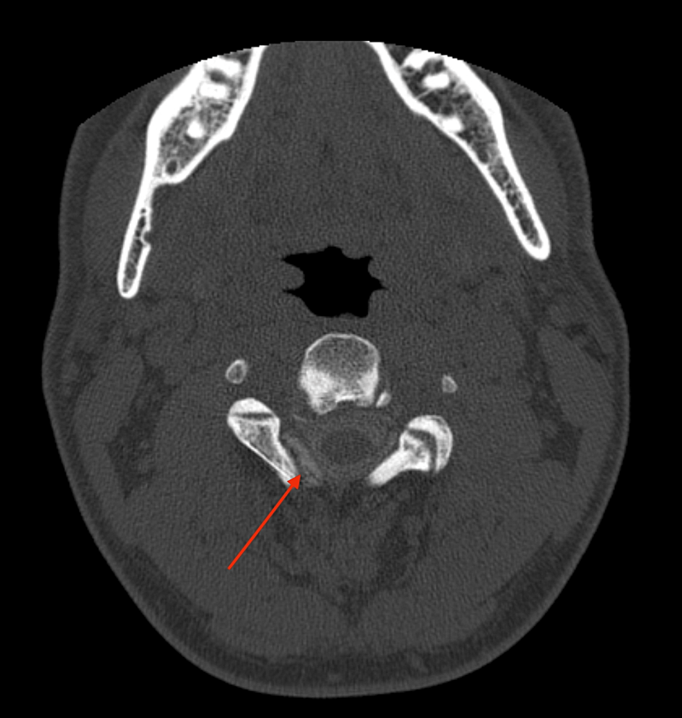 Axial-C2-C3-level-myelo-CT-showing-contrast-outside-the-subarachnoid-space-(red-arrow),-as-evidence-of-a-right-sided-C2-C3-CSF-fistula.