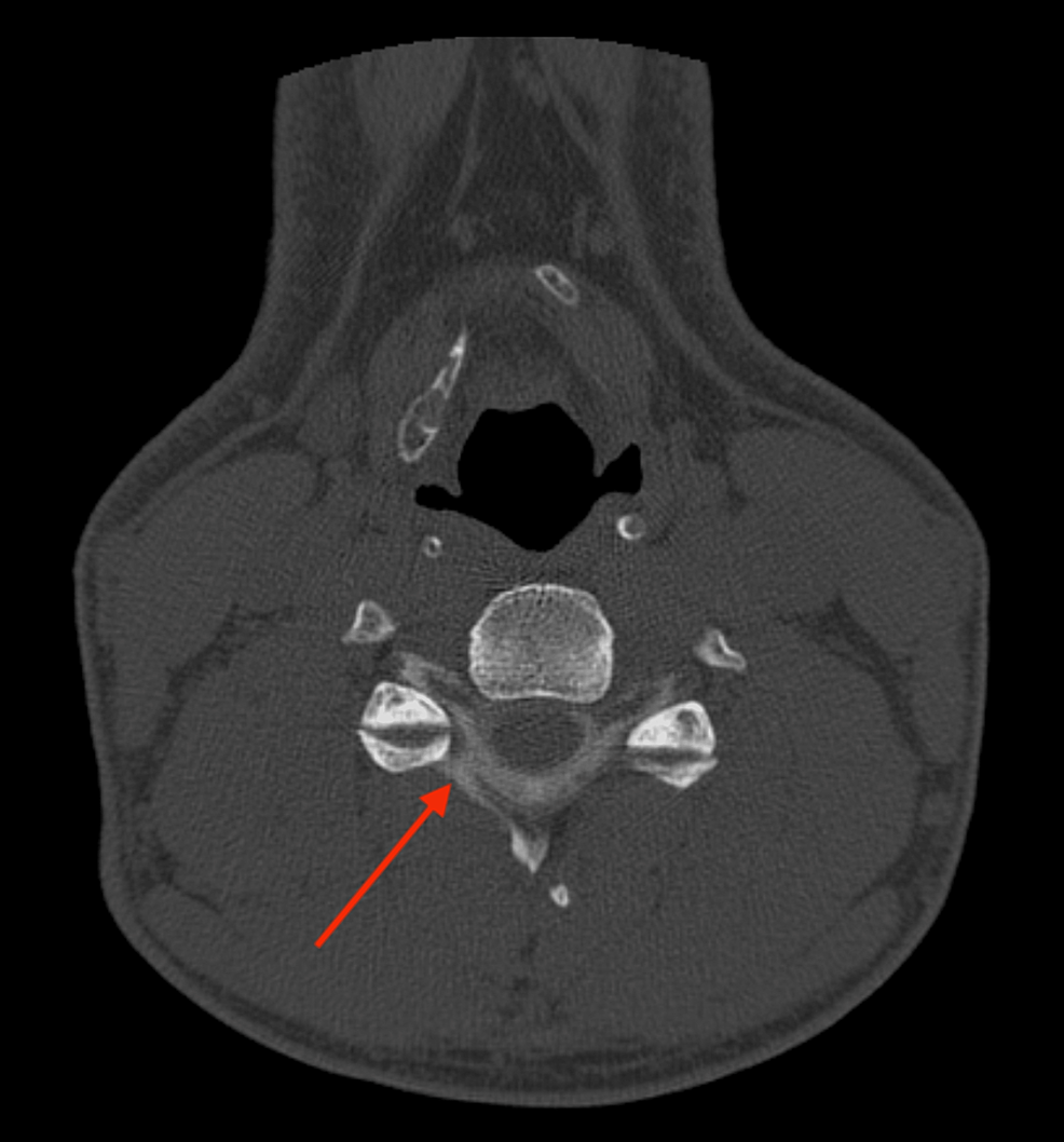 Axial-C4-C5-level-myelo-CT-showing-contrast-outside-the-kunoid-space-(red-arrow),-as-evidence-of-a-right-sided-C4-C5-CSF-fistula .