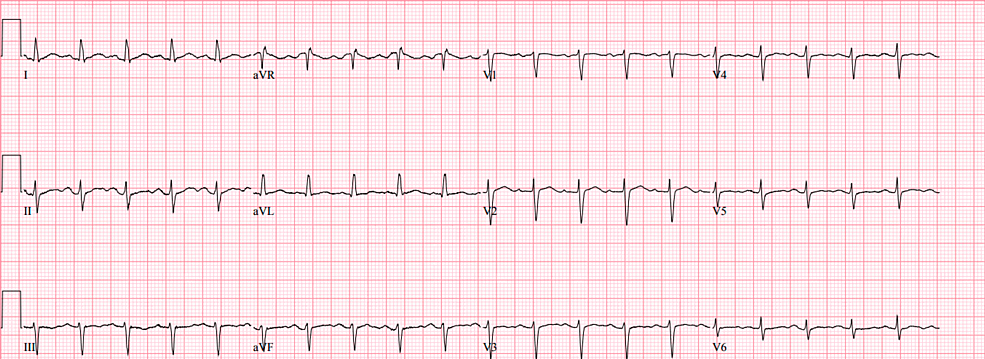 EKG-of-the-patient-while-on-modafinil-showing-sinus-tachycardia-with-a-ventricular-rate-of-121-beats-per-minute.