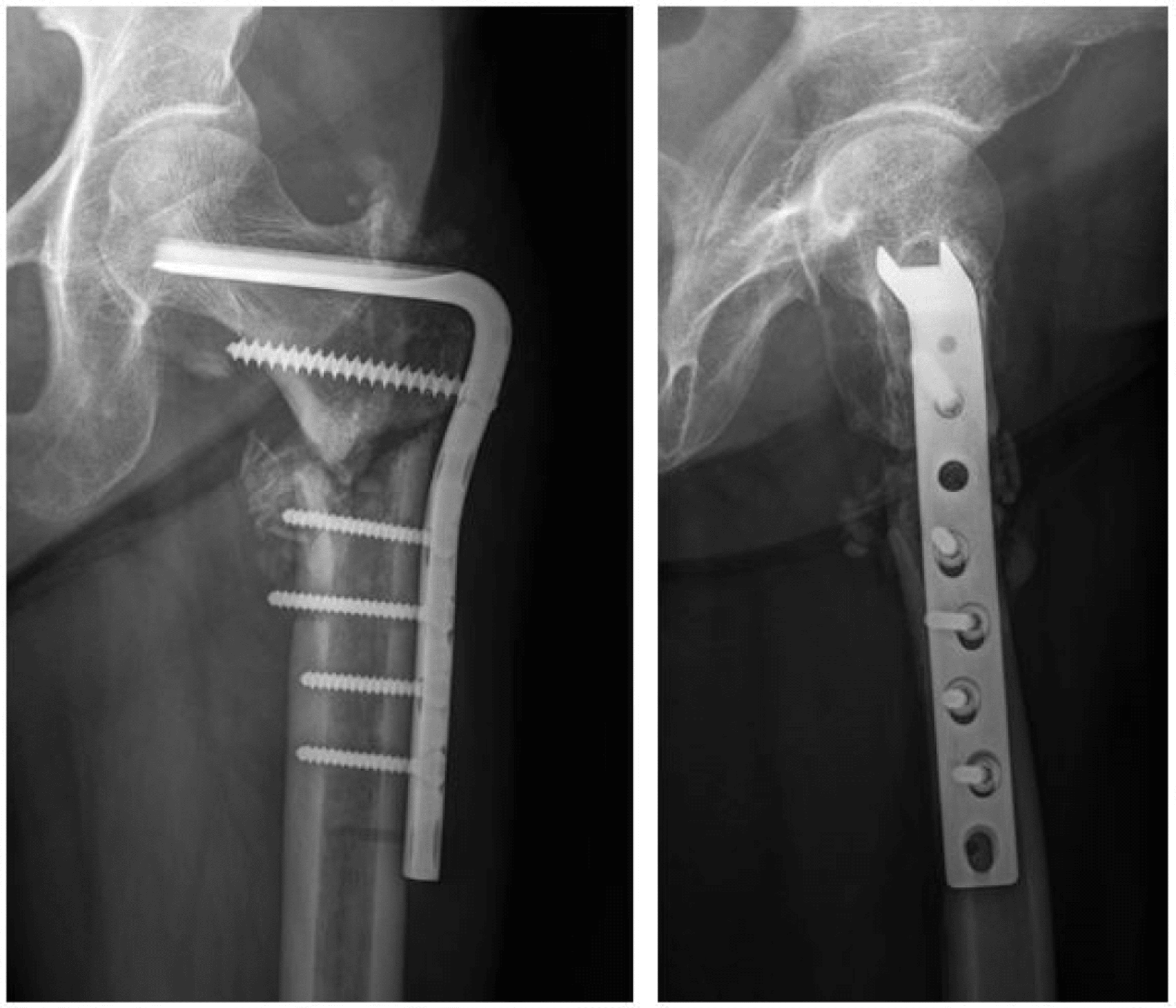 Cureus Bilateral Subtrochanteric Complete Atypical Femoral Fracture