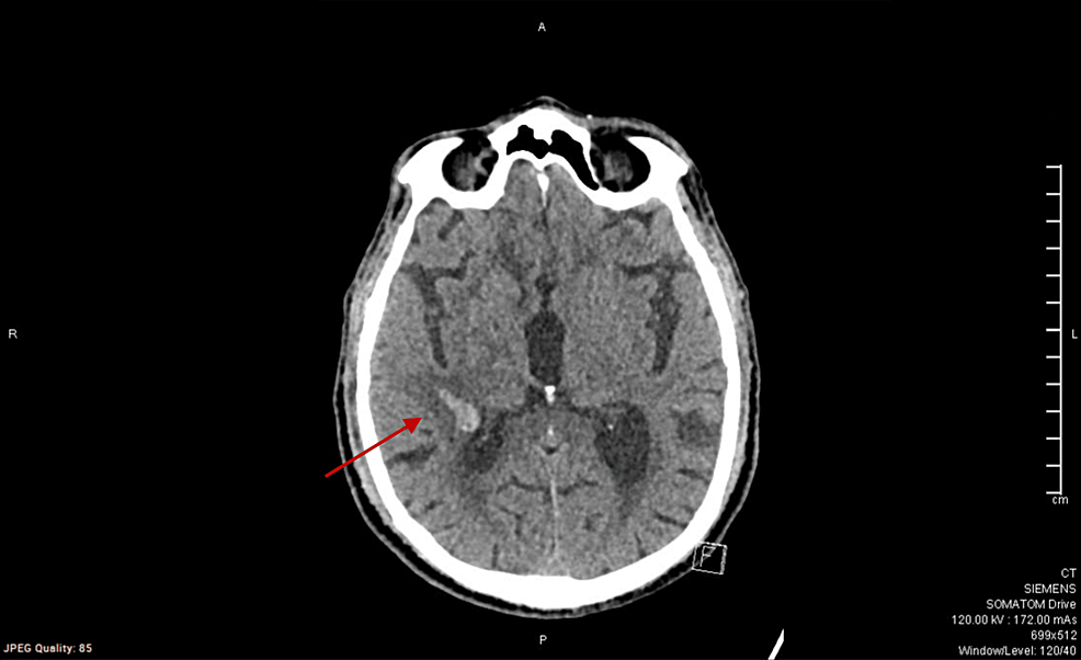 CT-of-the-head-without-contrast-showing-a-well-defined-parenchymal-hyperdensity-(red-arrow)-in-the-right-parietal-periventricular-location,-suggestive-of-parenchymal-bleed
