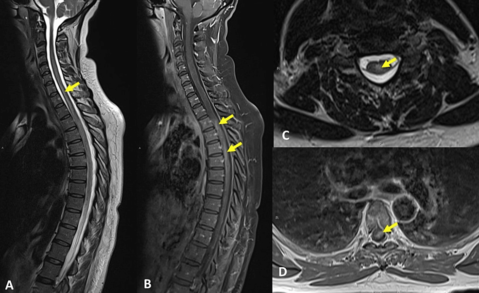 MRI-of-the-spinal-cord---(A)-sagittal-T2-weighted-sequence,-(B)-sagittal-contrast-enhanced-T1-weighted,-(C)-axial-T2-weighted-(C6-level),-and-(D)-axial-contrast-enhanced-T1-weighted-(T5-level).