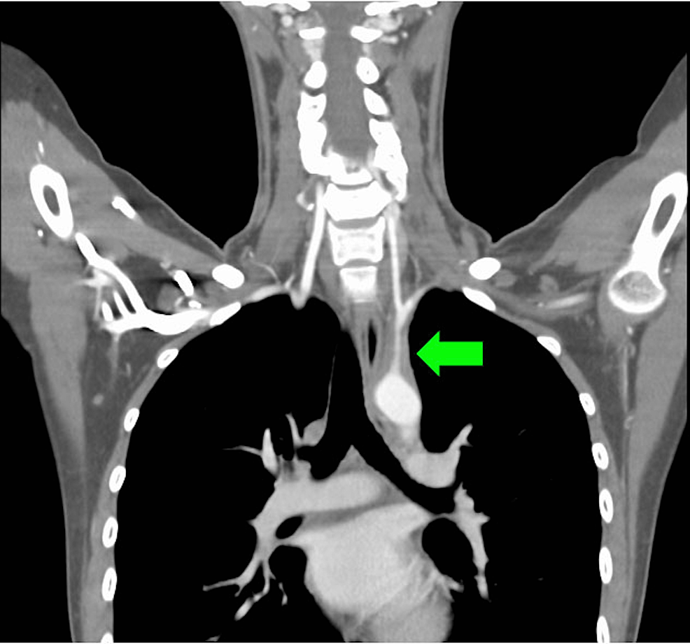 Contrast-enhanced-computed-tomography-scan-(sagittal-view)-exhibiting-wall-thickening-in-the-left-subclavian-(green-arrow)-artery-and-its-branches.