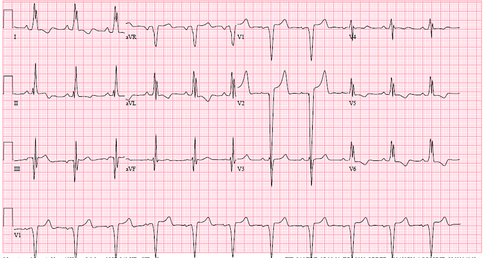 Cureus | Infective Endocarditis in Hypertrophic Obstructive ...