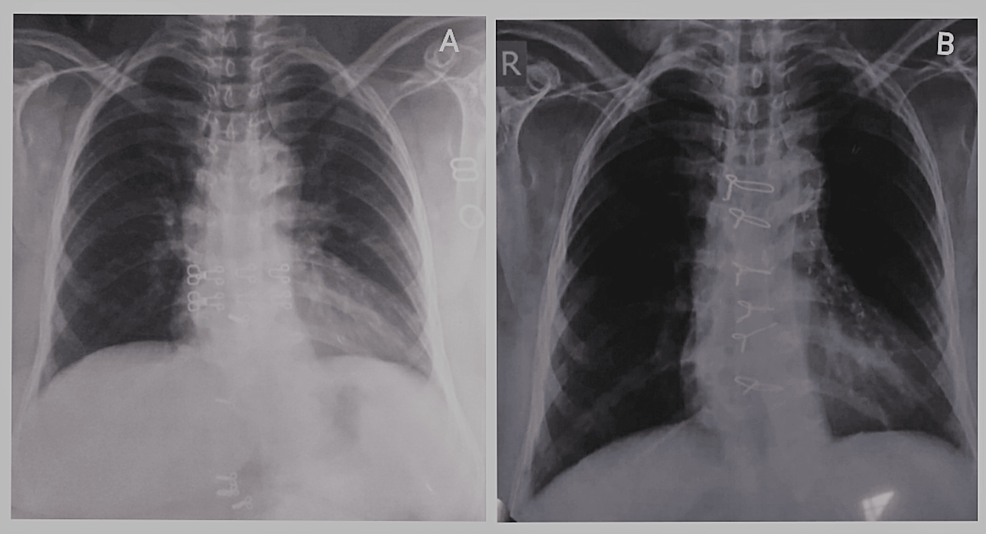 Pre-operative-chest-X-ray-showed-cardiomegaly-(A)-and-in-post-operative-chest-X-ray,-sternal-wires-and-cardiomegaly-were-noted-(B).