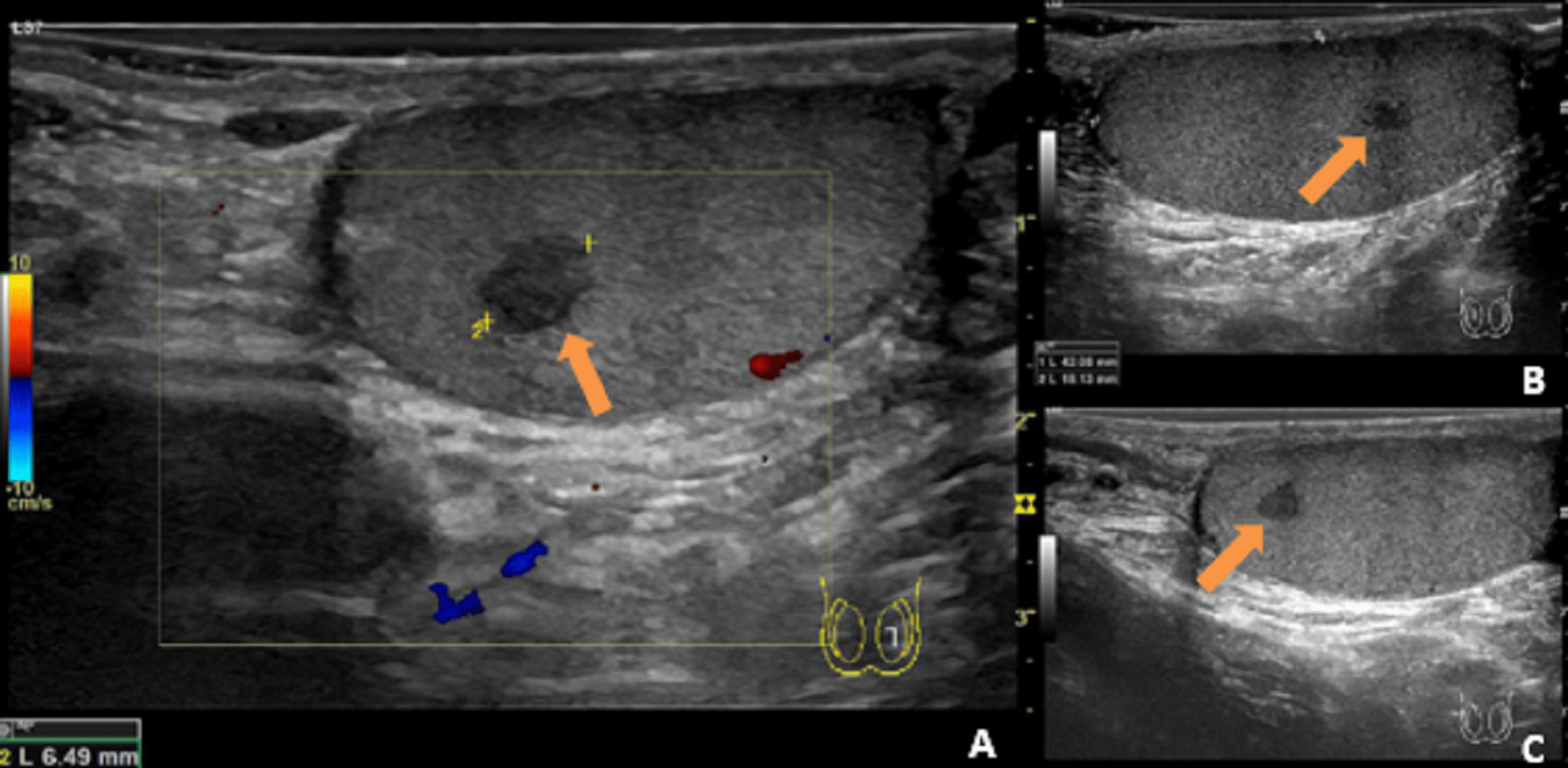 Cureus A Rare Case Of Sarcoidosis With Urologic Symptoms As The Presenting Feature 2229