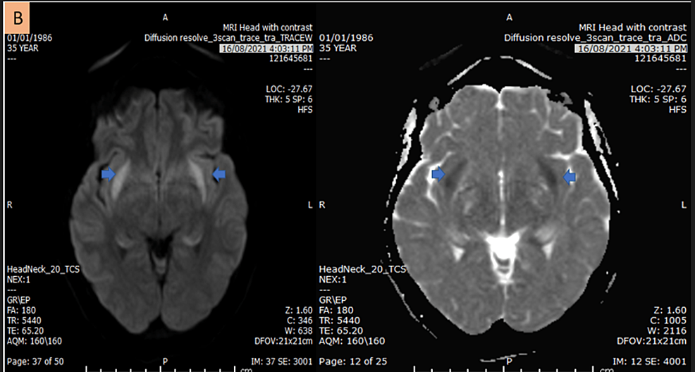 Head-MRI-axial-diffusion-and-ADC-map-demonstrate-symmetrical-claustrum-diffusion-restriction-(blue-arrow).