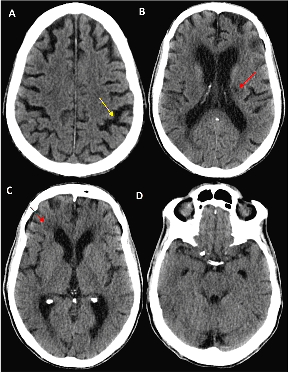 myoclonic-jerks-and-ataxia-a-case-of-rare-neurological-side-effects-of