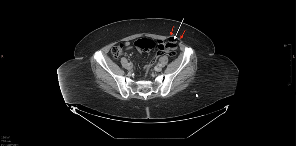 CT-of-the-abdomen-and-pelvis-post-contrast-displaying-a-left-spigelian-hernia-with-small-bowel-content-(white-arrow).-also seen-is-the-intact - External oblique aponeurosis - (red arrow).