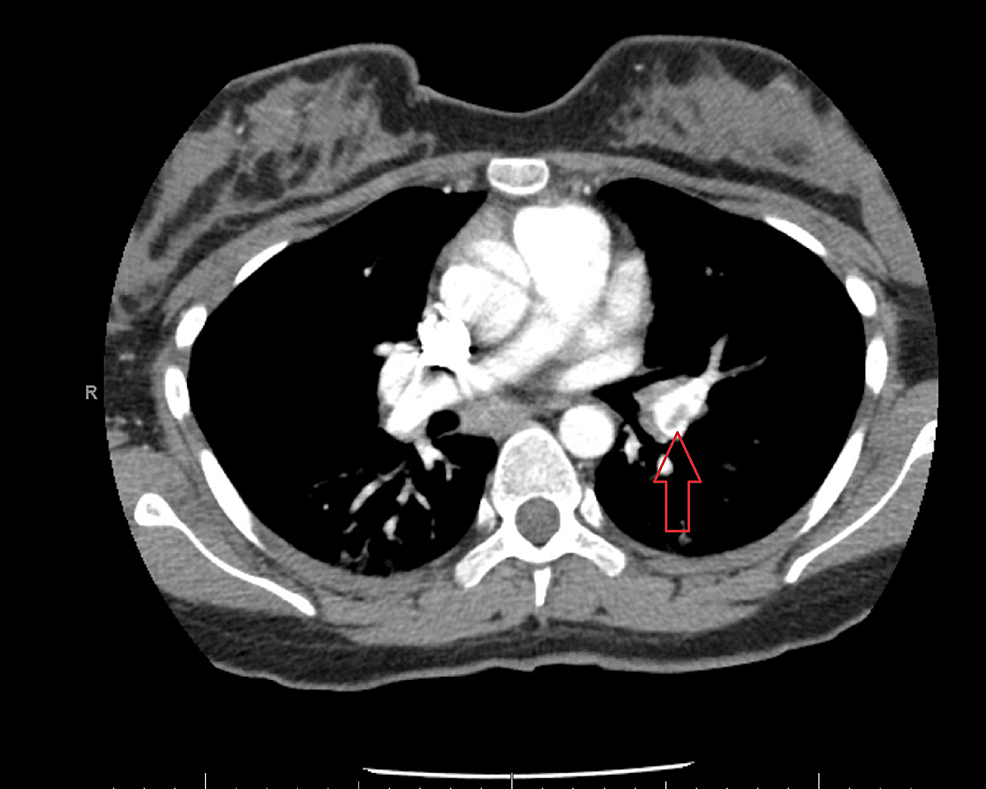 Cureus | Unexpected Thrombocytopenia in a Parturient With Evans ...