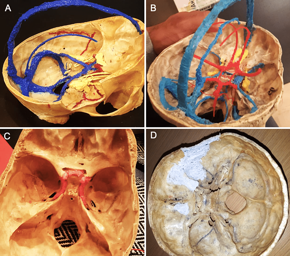 (A,-B)-The-dural-venous-sinuses-(blue),-the-circle-of-Willis-(red),-and-cranial-nerves-III,-IV,-and-V-(yellow)-have-been-three-dimensional-(3D)-printed-to-demonstrate-their-course-in-relation-to-the-skull-base.-(C)-The-course-of-the-internal-carotid-artery-(red)-is-easily-traceable.-(D)-3D-printing-can-be-used-to-preserve-or-reconstruct-defective-bone-parts-and-anatomical-models.-