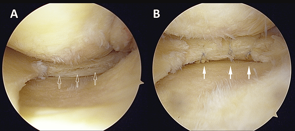Arthroscopic-views-in-the-patient's-left-knee