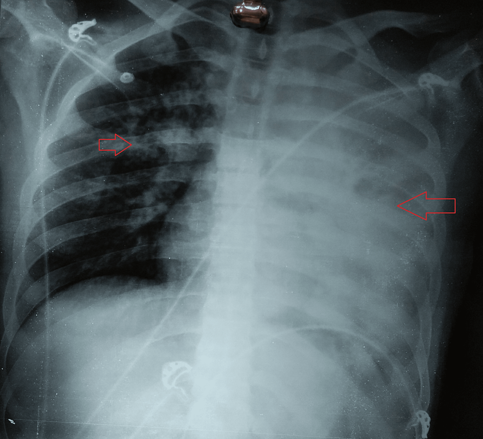 Chest-radiograph-(P-A-view)--showing--consolidation-on-the-left-upper-and-lower-lobes-and-right-upper-lobe
