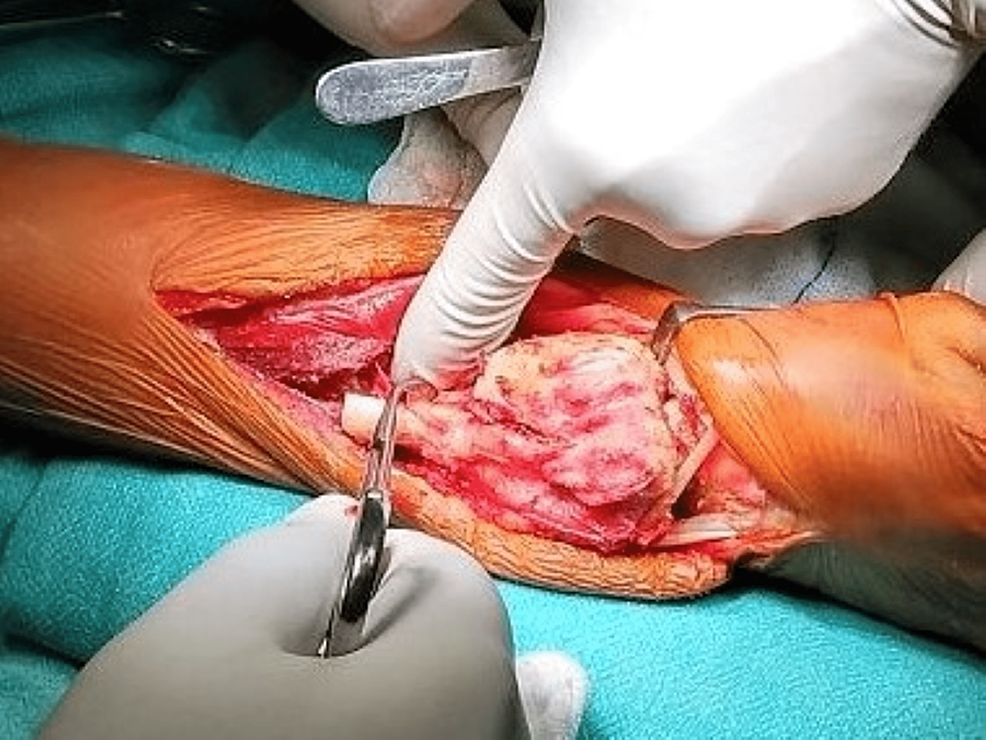 Intraoperative-picture-showing-wide/en-bloc-excision-of-the-tumor