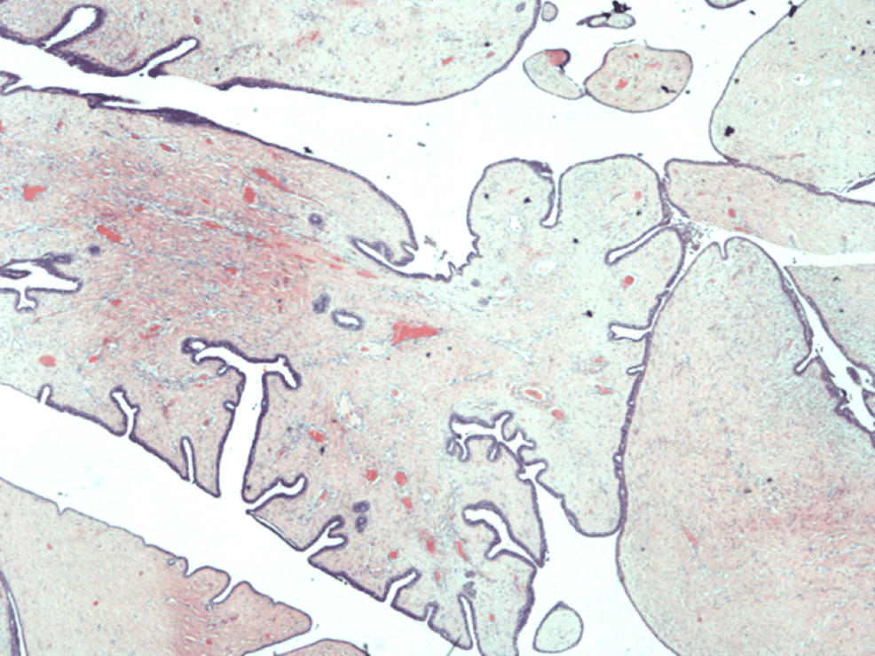 cureus-primary-benign-phyllodes-tumour-of-the-labia-minora-an