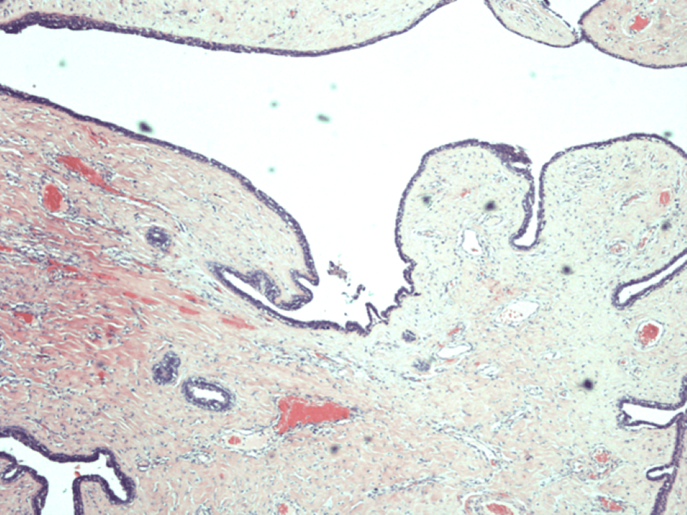 Cureus Primary Benign Phyllodes Tumour of the Labia Minora An