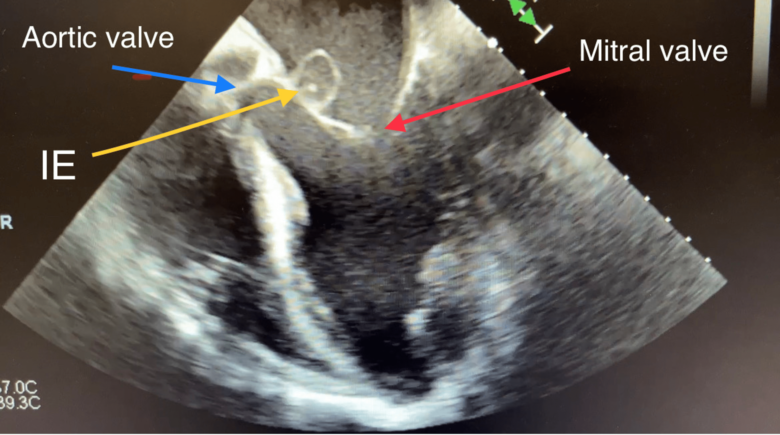 Cureus Aortic And Mitral Valve Infective Endocarditis Caused By