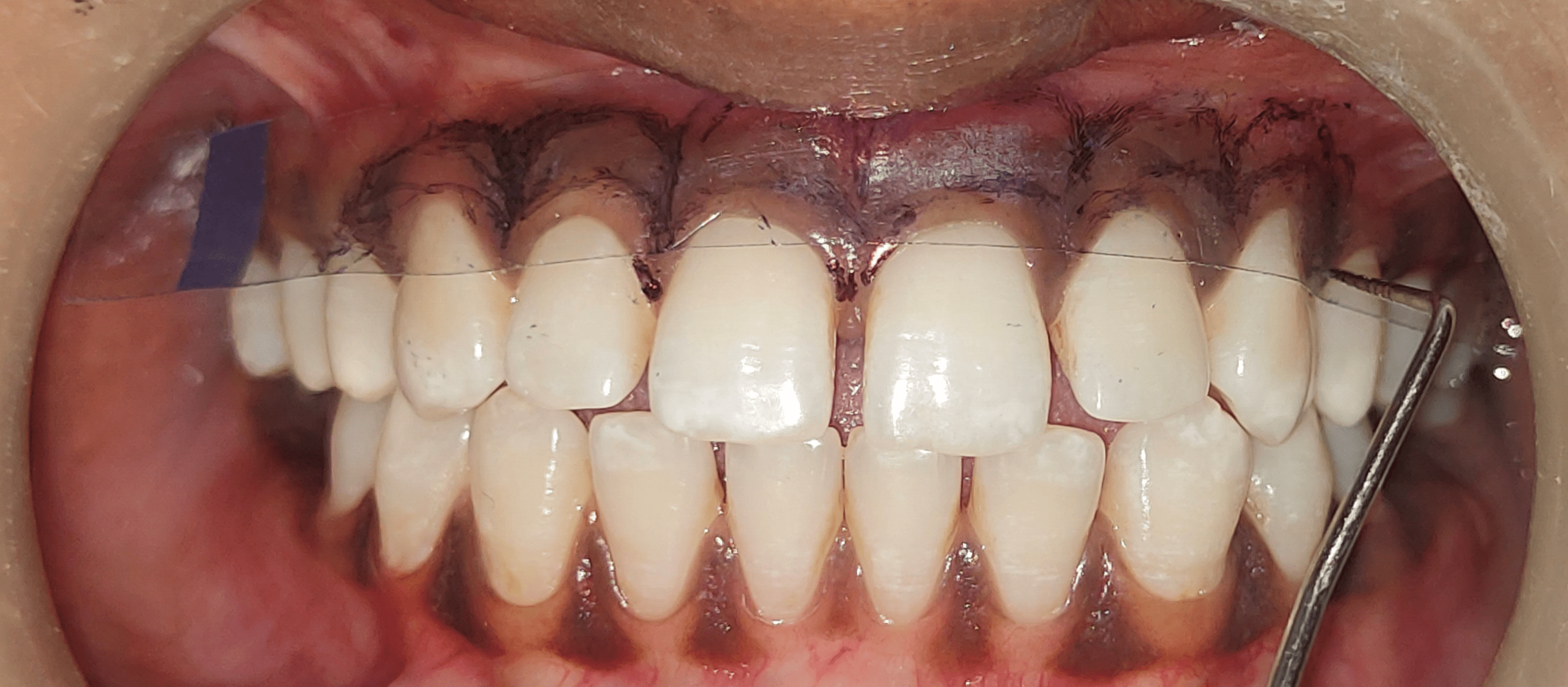 Cureus A Comparison Between the Efficacy of Scalpel and Laser
