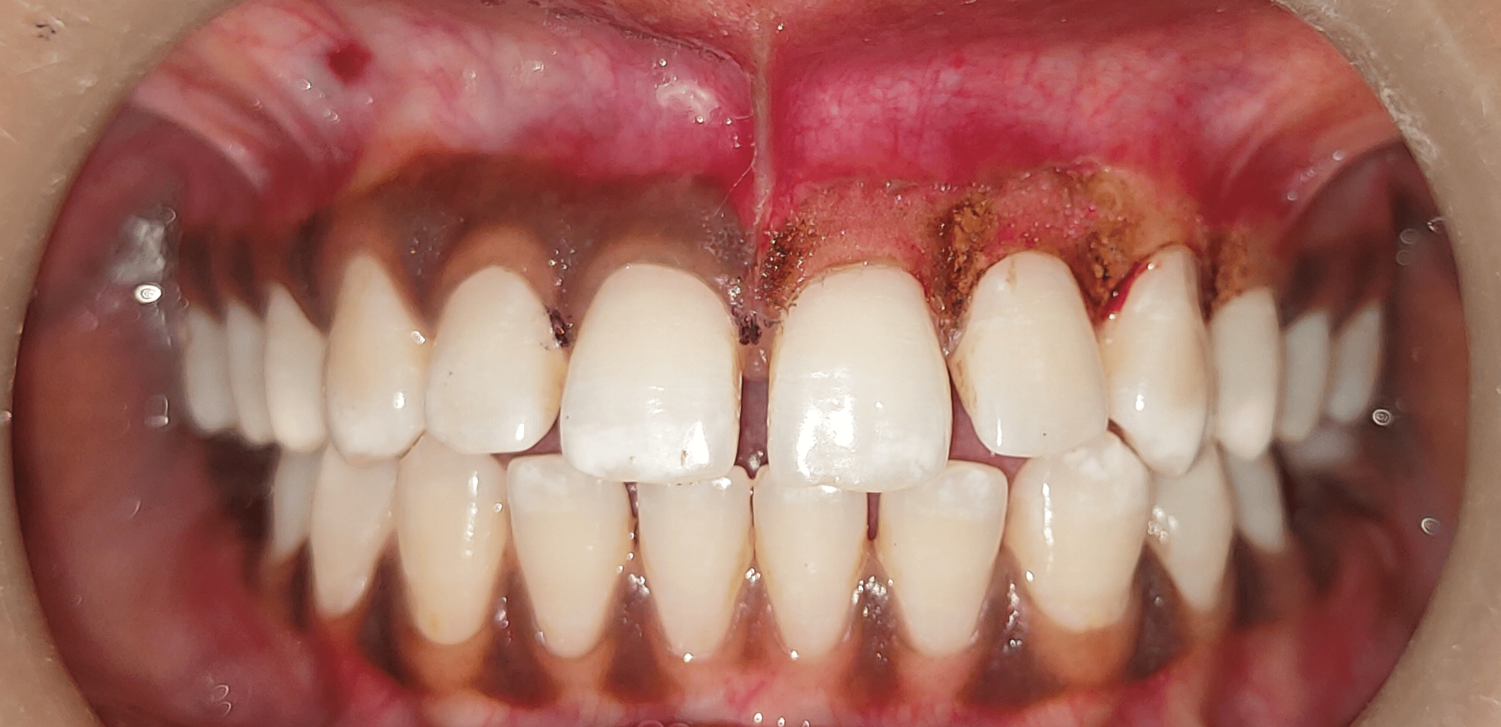 Cureus A Comparison Between the Efficacy of Scalpel and Laser
